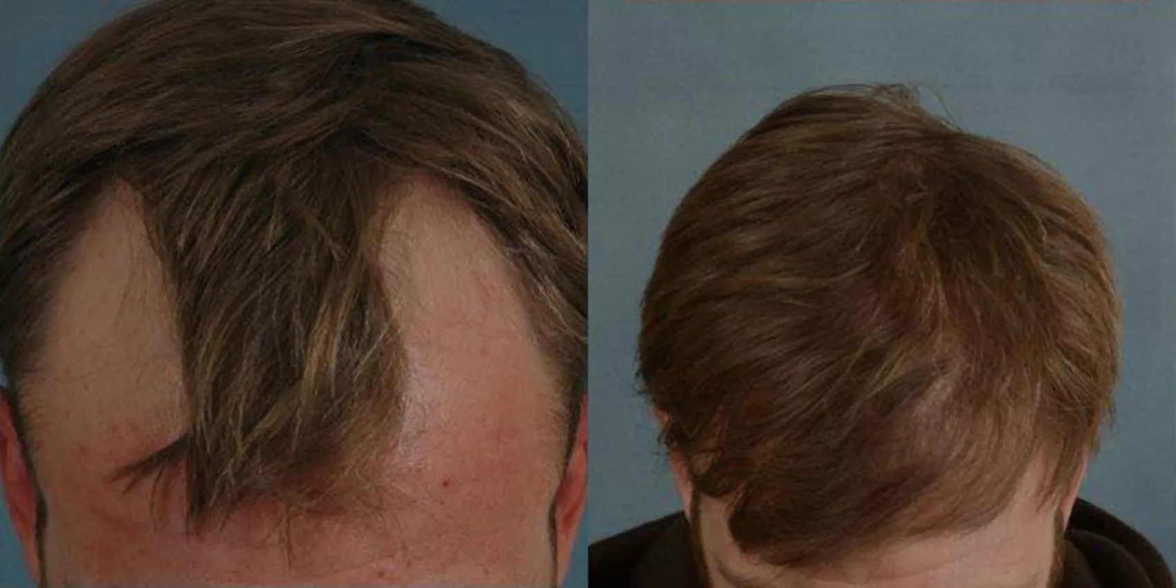 After Hair Transplant