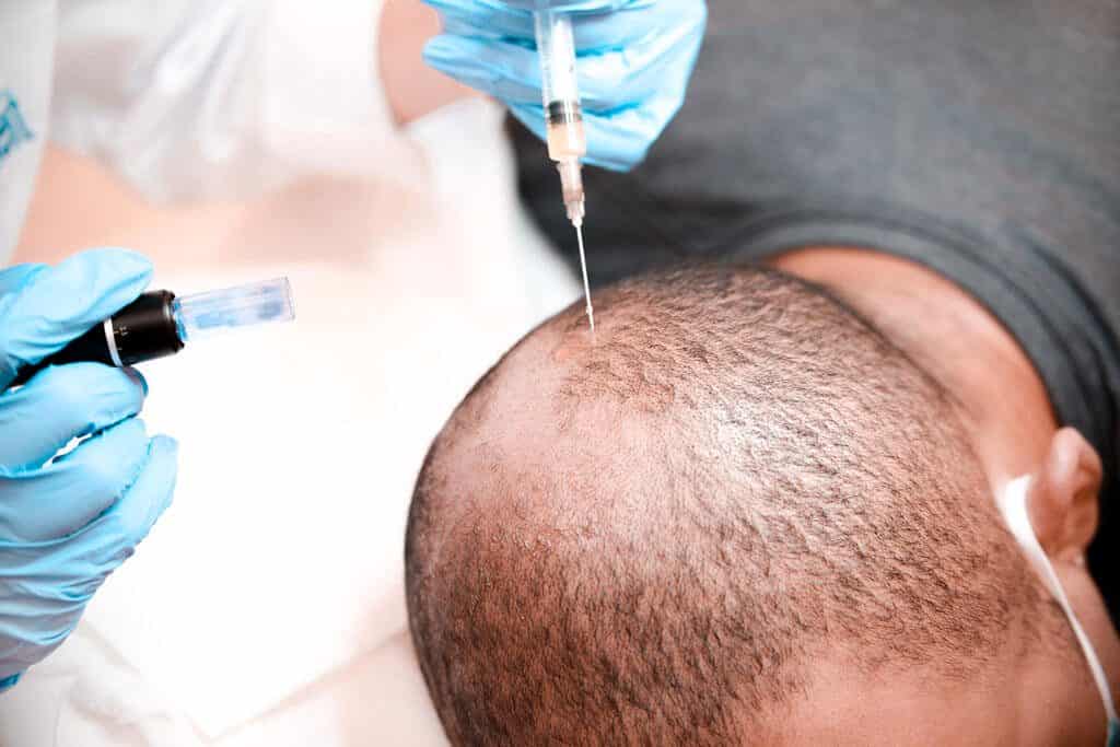 Hair Transplant Procedure